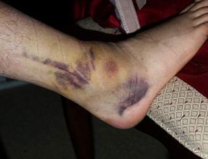 Downey Slip and fall accident attorney